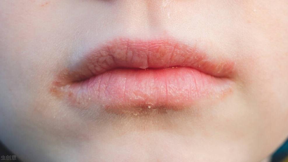 舌舔唇炎，嘴唇红肿疼痛干裂，你得这么治疗，才能避免慢性化
