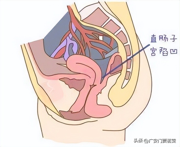 解析直肠前突的治疗方法,直肠前突是什么意思啊