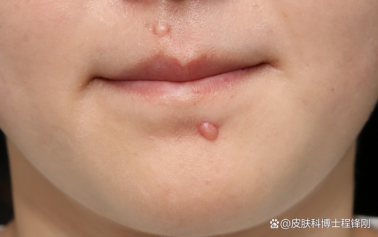 祛痣不长毛了,祛痣祛不掉