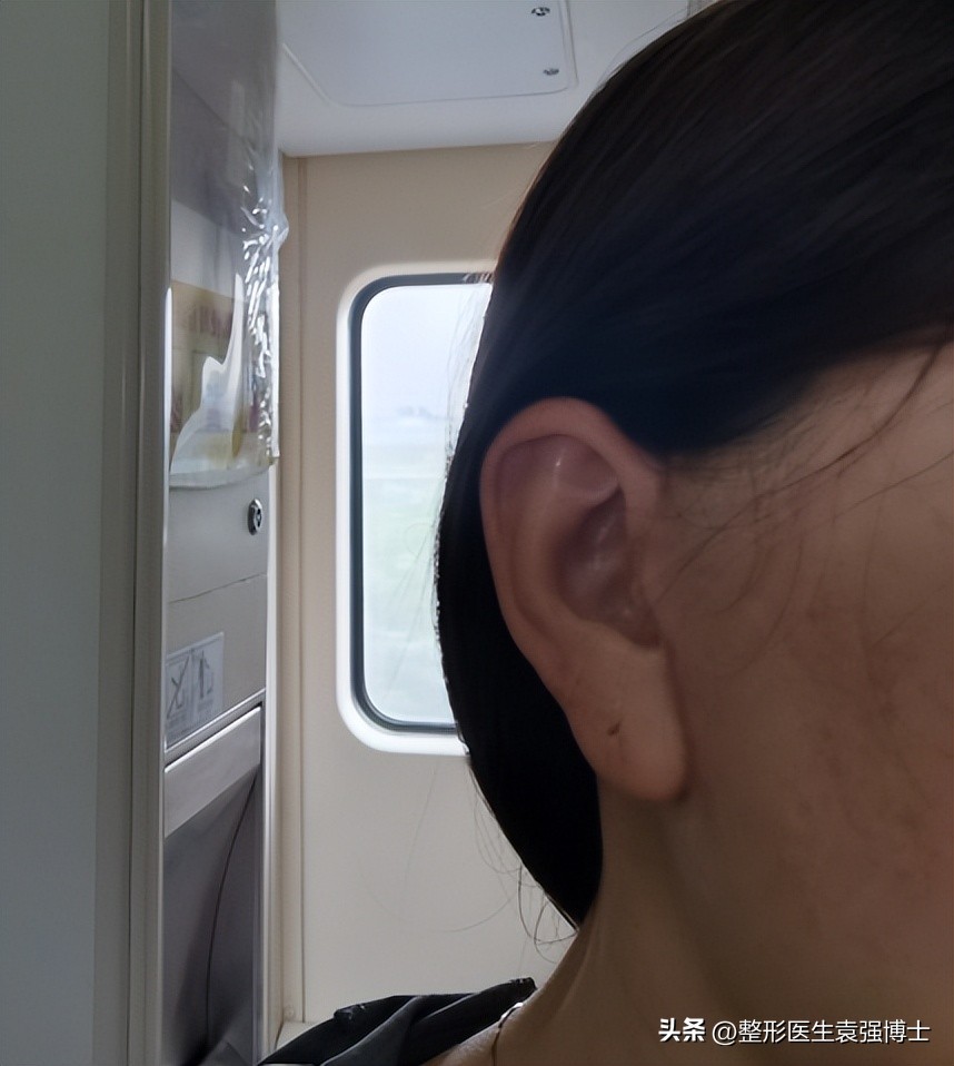 北京做大拉皮前后对比照片图文,面部做大拉皮提升的真实案例