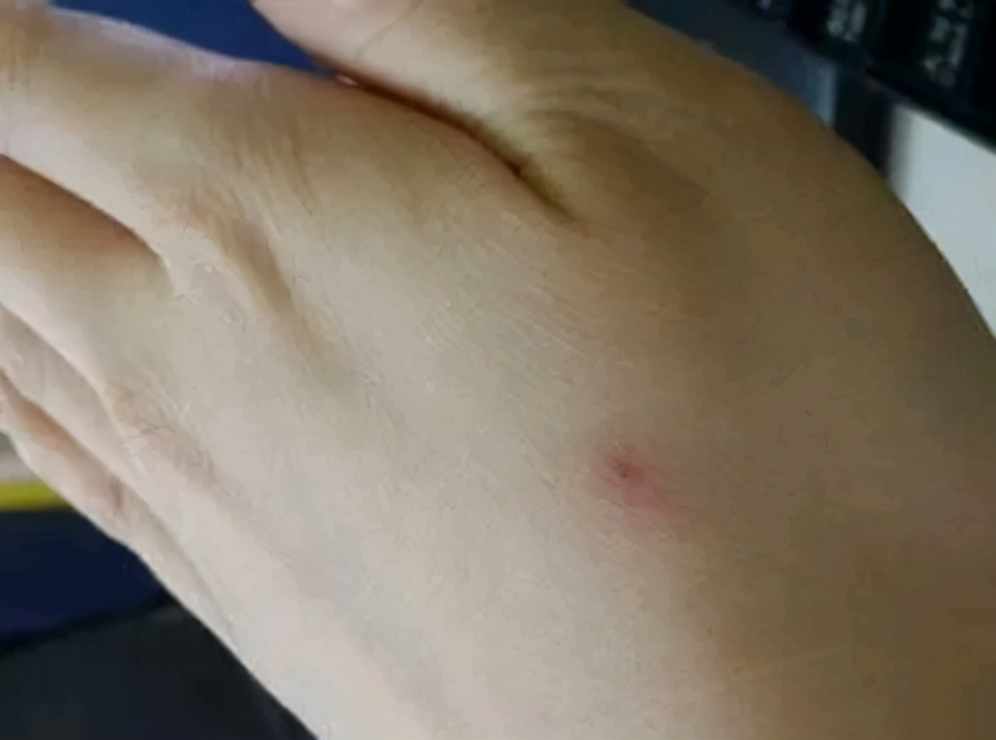 肝硬化身上长小红点痒是什么征兆,肝硬化脚面出了好多小红点有点肿