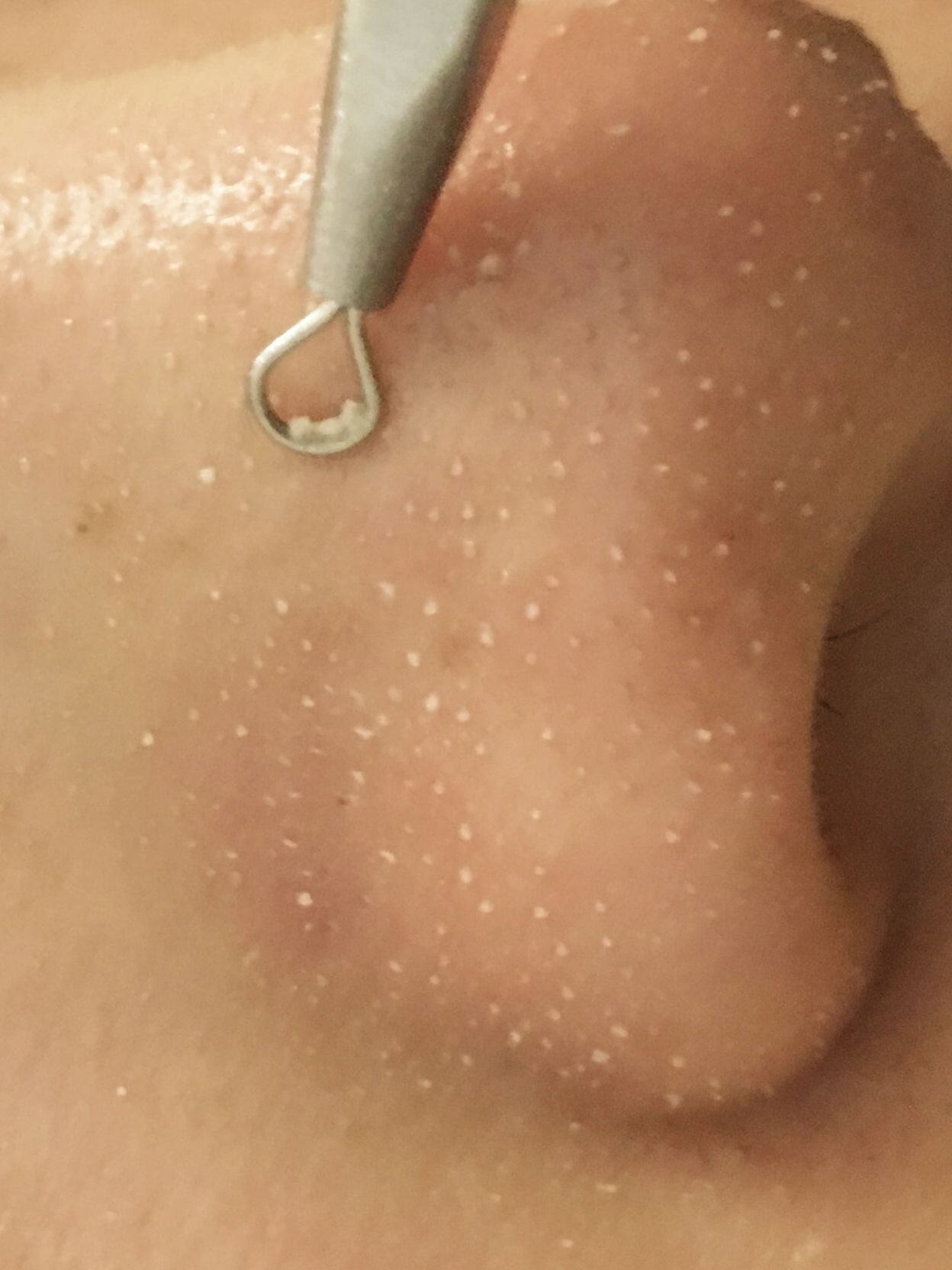 毛孔堵塞毛孔发黑怎样清理,毛孔长螨虫堵塞毛孔怎么办