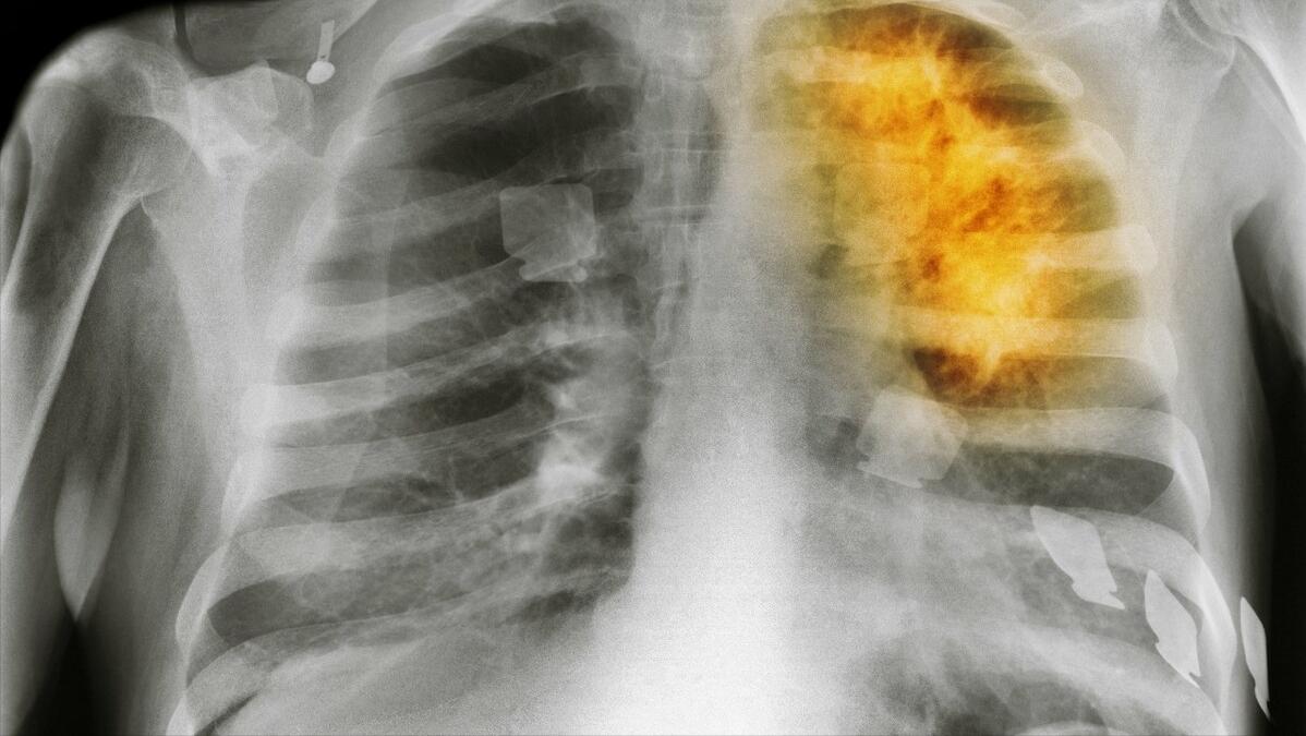 中年人弯腰驼背怎样引起的,老年人弯腰驼背是正常现象