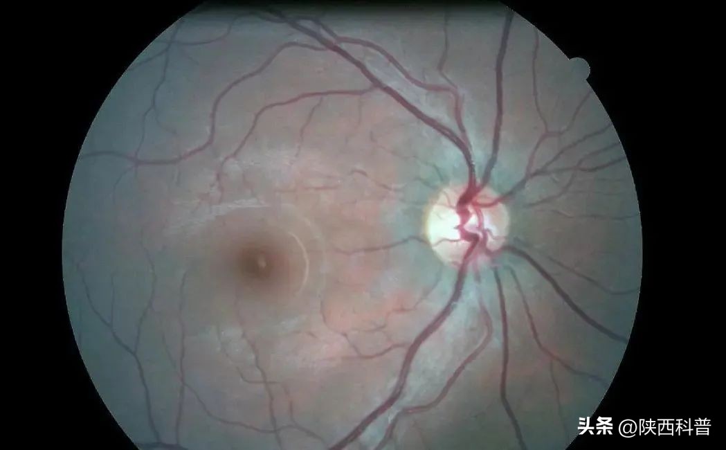 用眼过度导致眼睛凹陷,用眼过度肿起来了