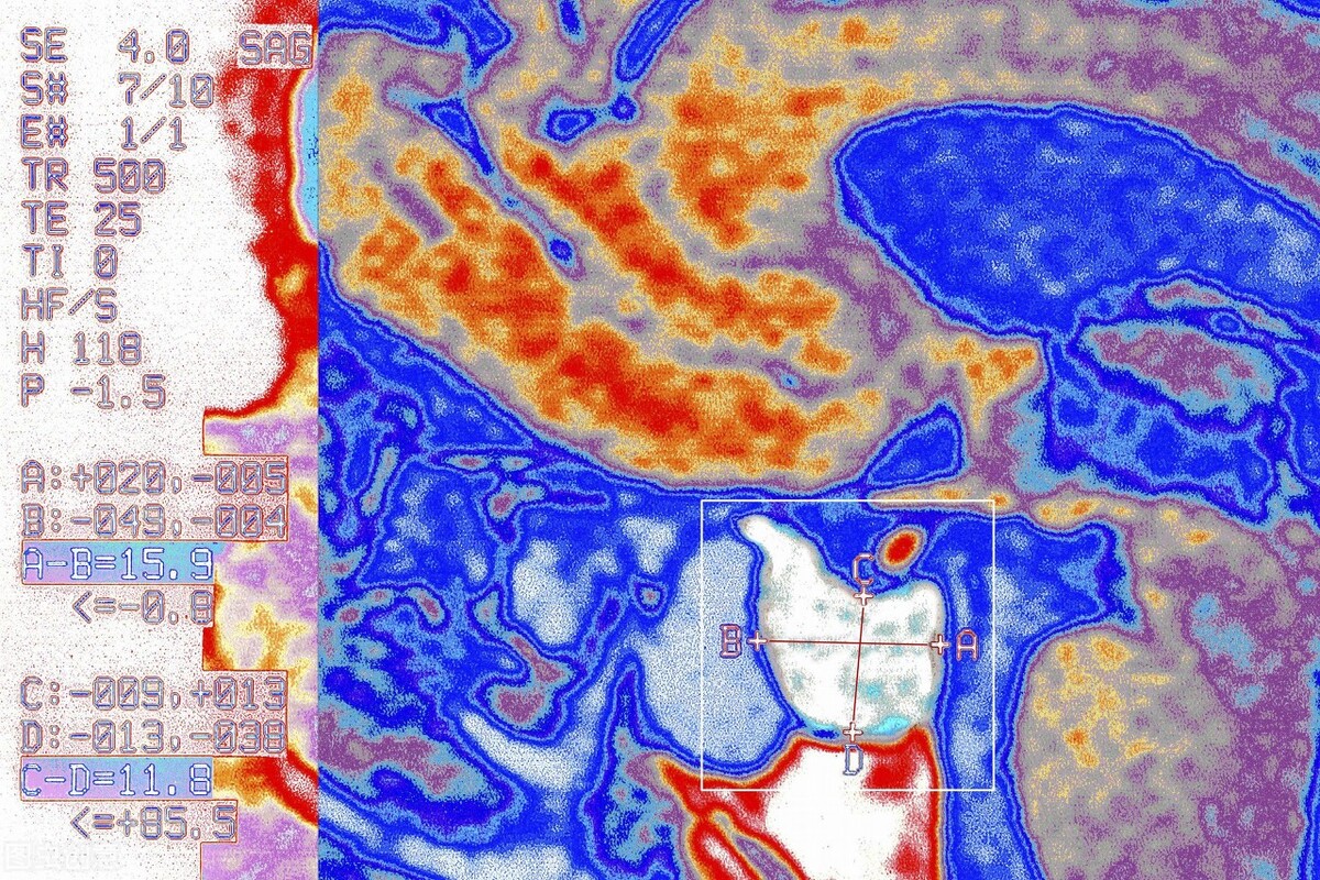 垂体瘤患者放射治疗能彻底治愈吗,垂体瘤术后有残留伽玛刀能切除吗