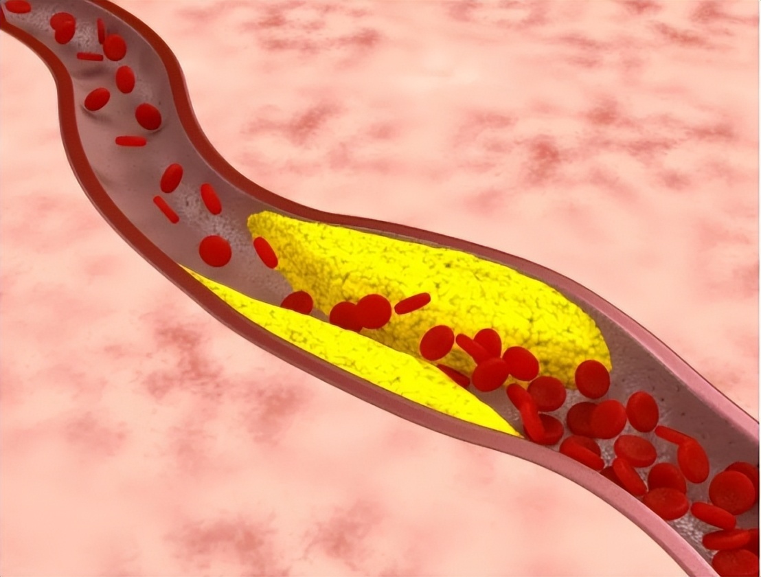 冠心病诊断预测模型,建模预测冠心病