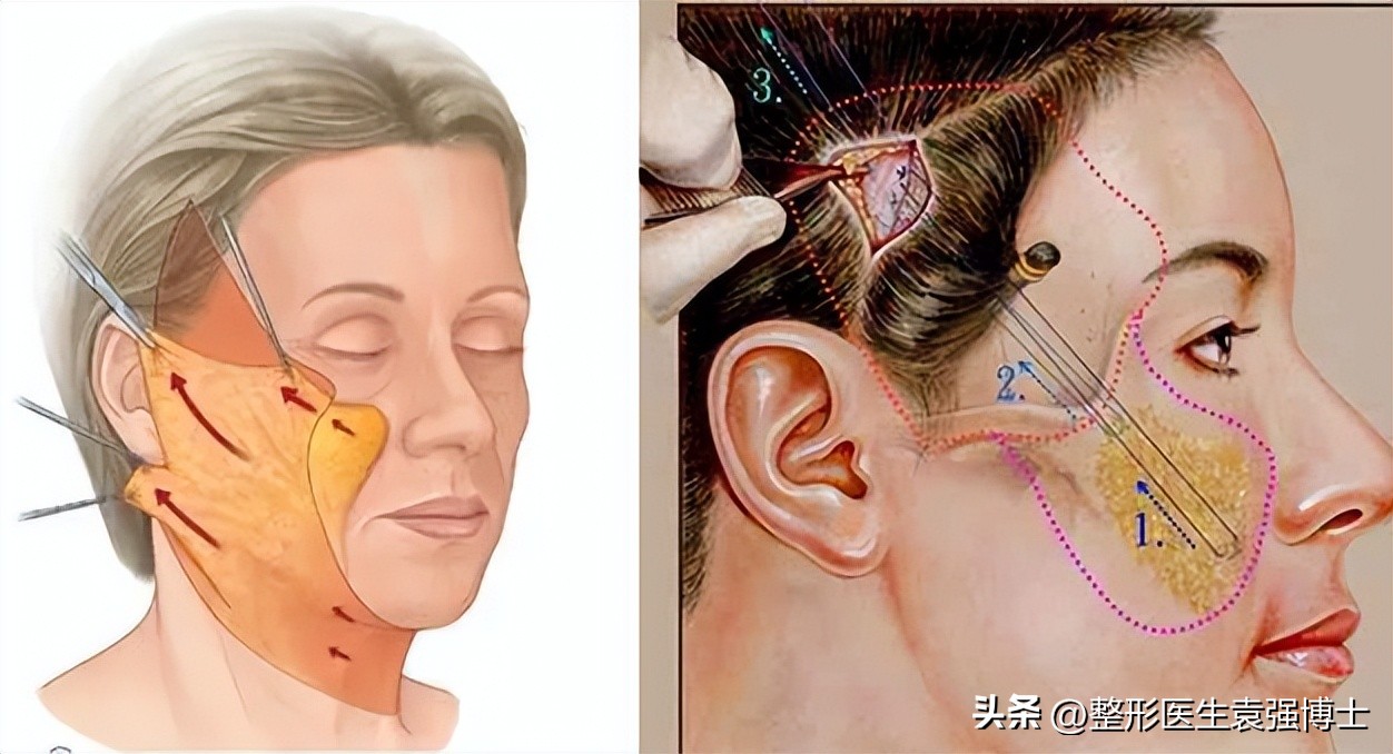 拉皮很贵吧,拉皮贵吗