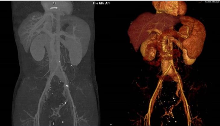 男子常便血去医院检查一看吓坏了,男子便血以为是痔疮一查竟是肠癌