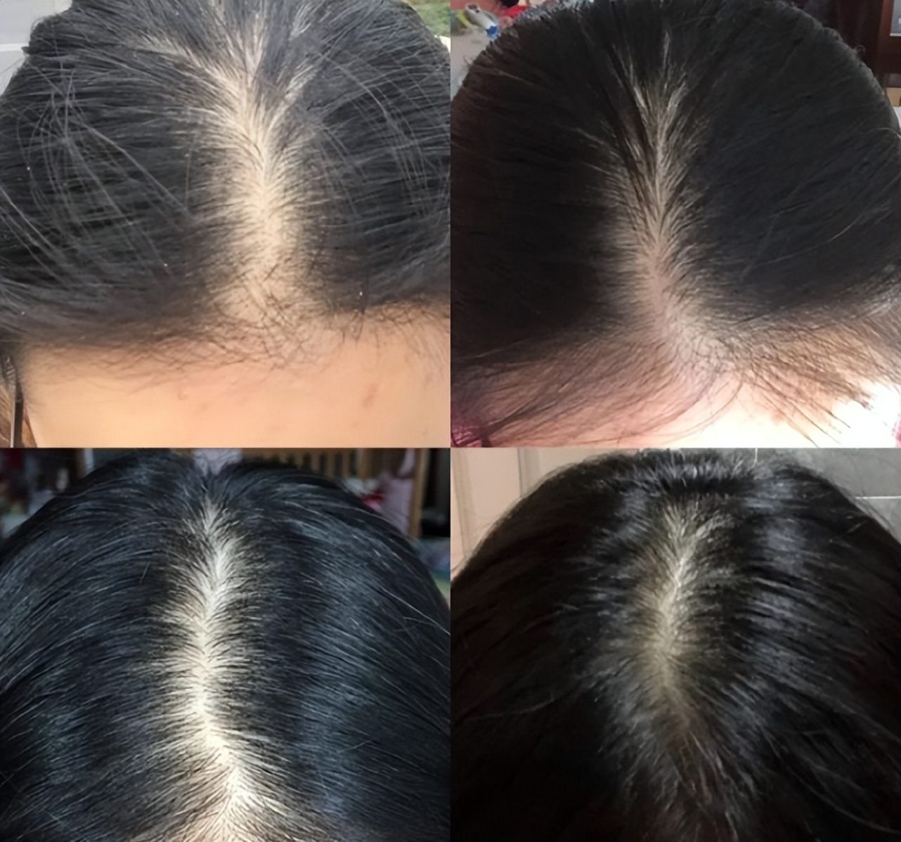 轻松解决脱发养出坚韧厚发,脱发严重这个防脱发妙招很好用