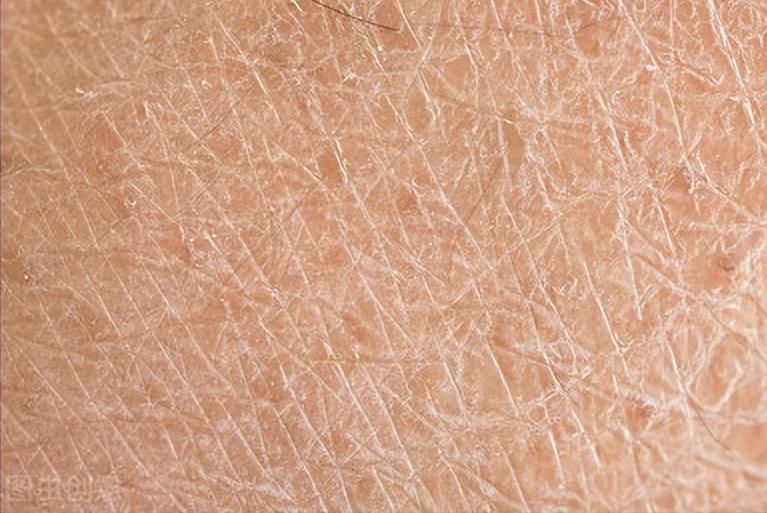 鱼鳞病能彻底治愈吗,鱼鳞病能不能彻底治愈