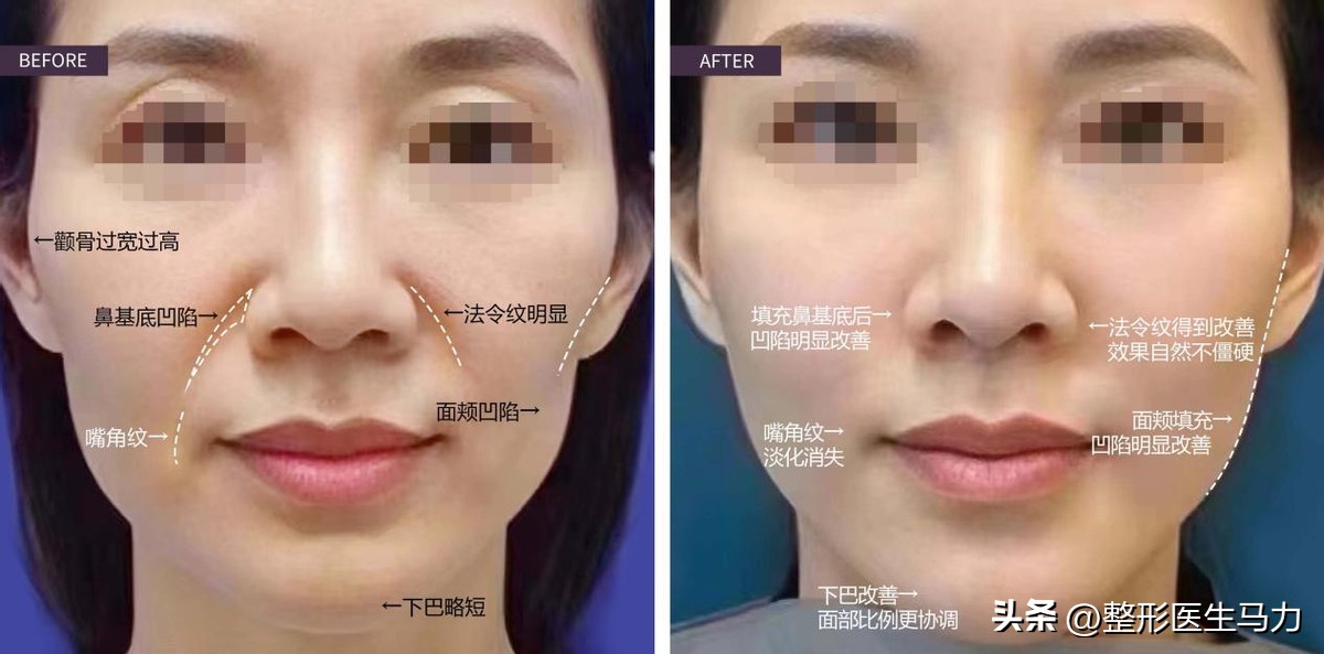 鼻基底玻尿酸栓塞后续治疗方法,鼻基底打玻尿酸栓塞后打溶解酶