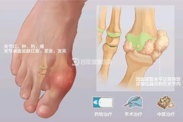 氢气水能治痛风吗,求治疗痛风特效药