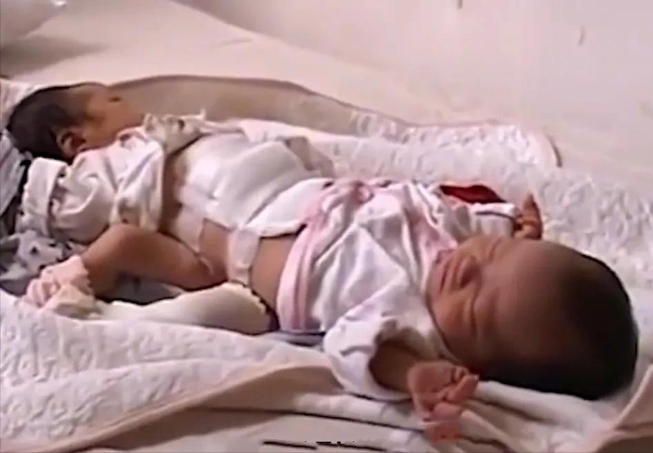 女子生下连体双胞胎后续,女子产下同母异父双胞胎完整版