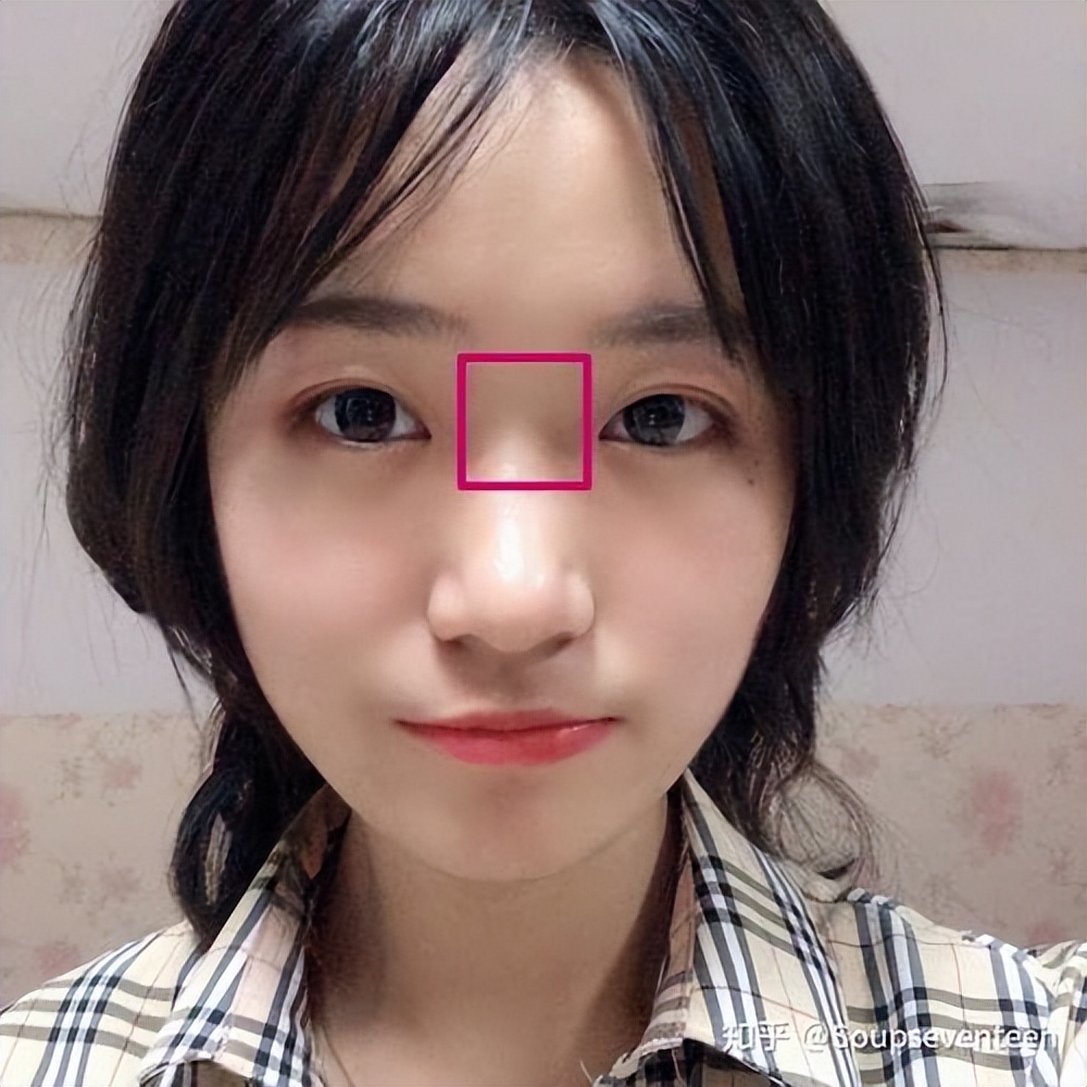 塌鼻子后期能改善吗,塌鼻子怎么改善有效