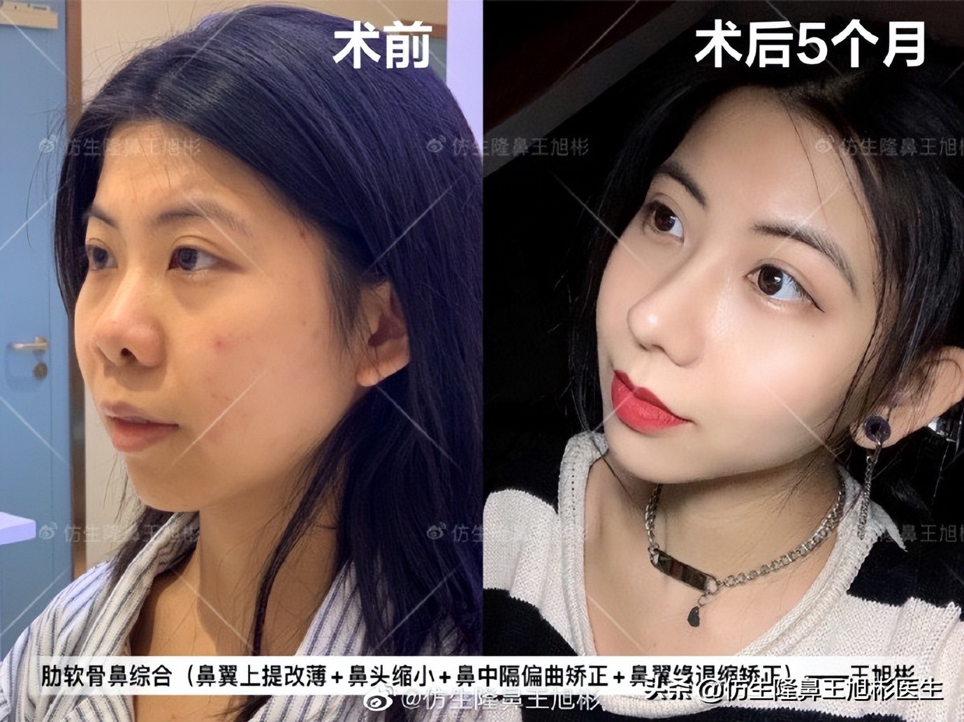 鼻翼缘退缩要如何矫正|王旭彬隆鼻