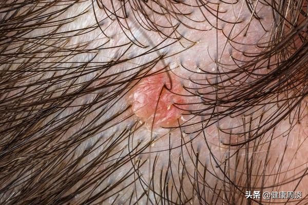头皮发痒长疙瘩什么原因造成的,头皮发痒长疙瘩是什么原因引起的