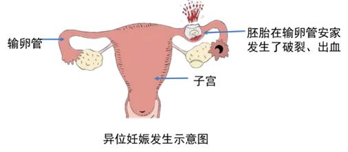 疫情封控在家，要小心宫外孕