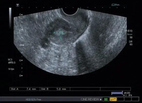 B超详解带你了解“子宫内膜息肉”