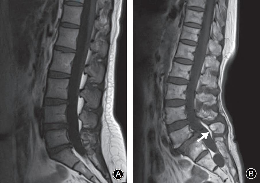 峡部裂和隐性峡部裂有区别吗,单纯峡部裂可以做峡部修复吗