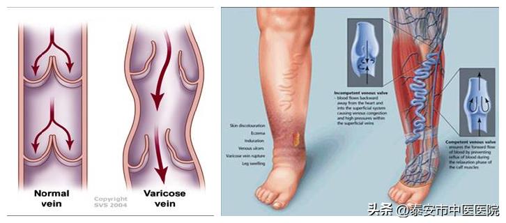 下肢静脉曲张引起的溃疡康复理疗,中医治疗下肢溃疡