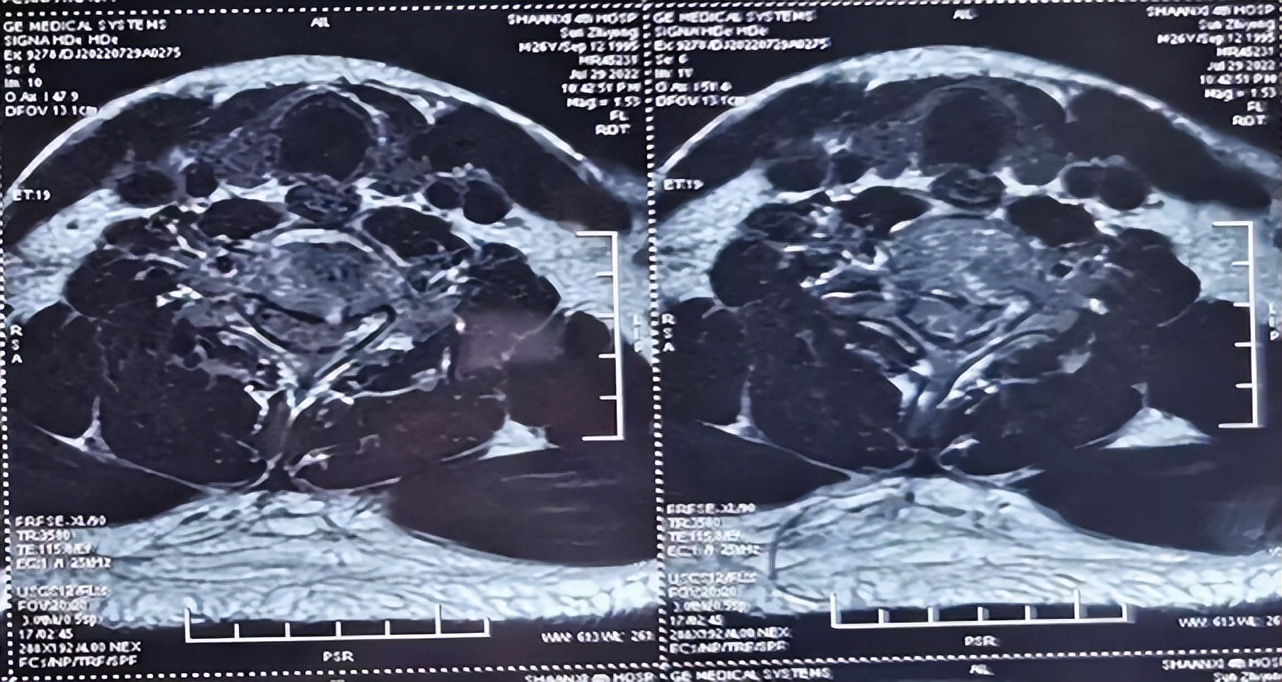 120紧急救援落石砸伤男子,紧急救援男人被电梯压死
