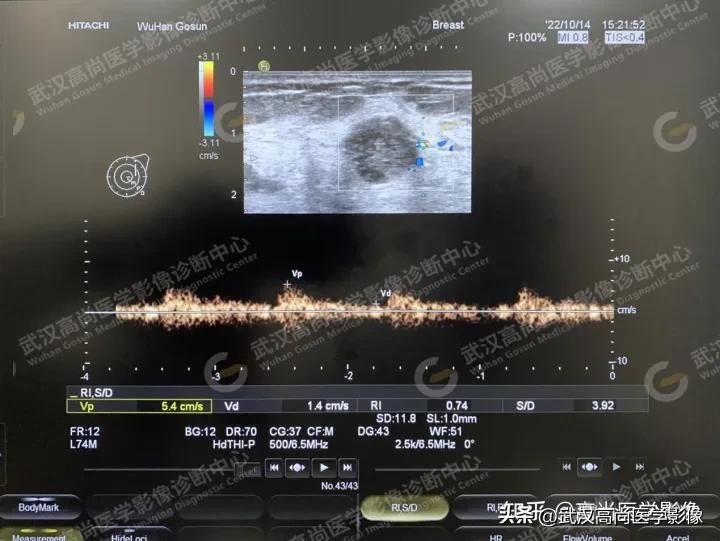 乳腺超声病例,乳腺肿块巨大超声结果4a