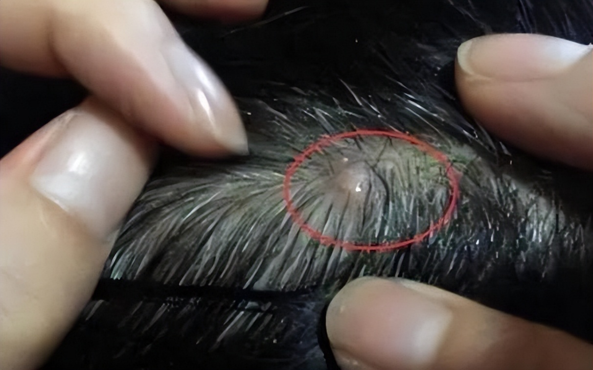 头上起疙瘩有脓包还掉发什么原因,老人头上总是起脓包疙瘩