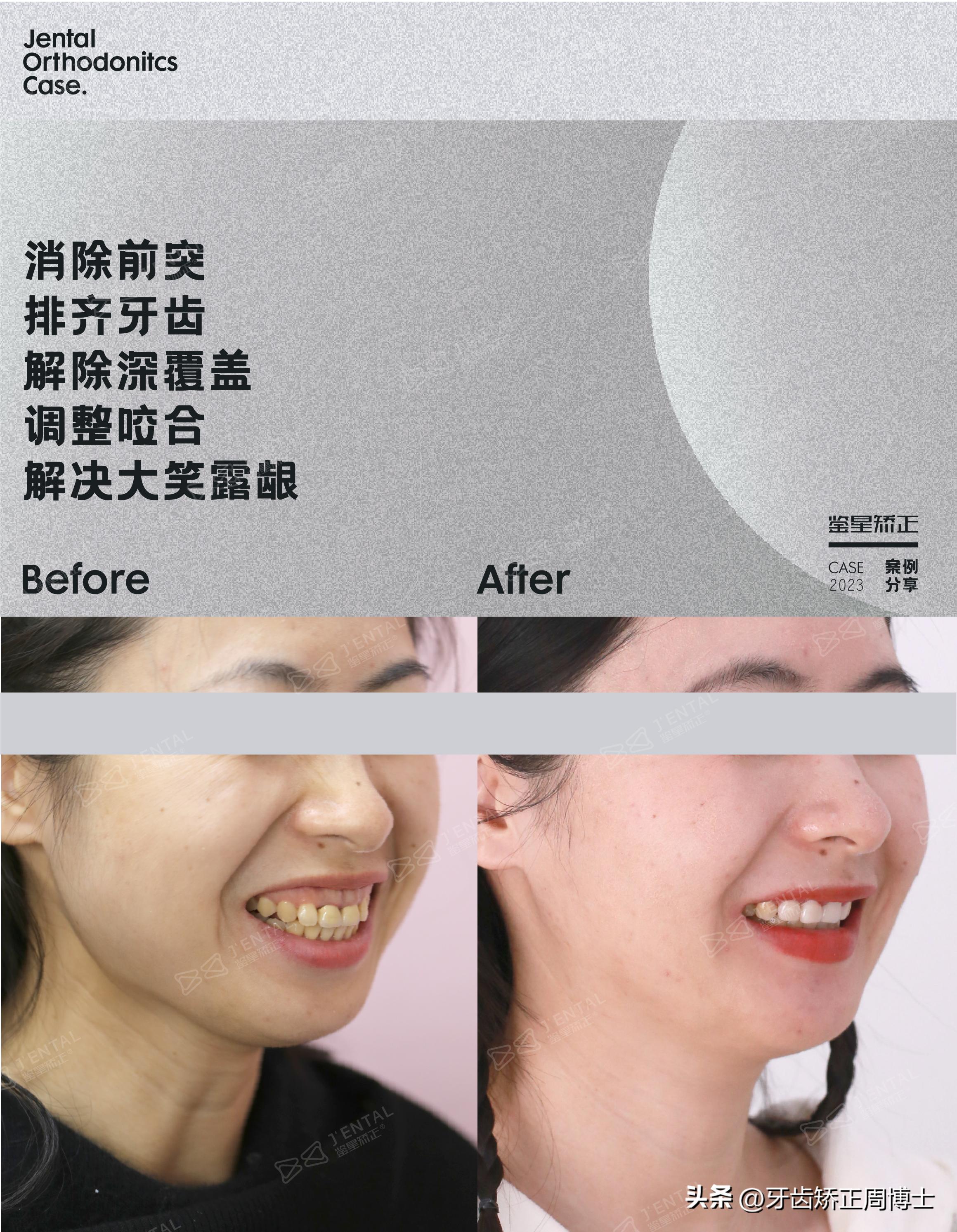 骨性前突下巴后缩可以矫正吗,上颌骨前突下巴后缩如何矫正