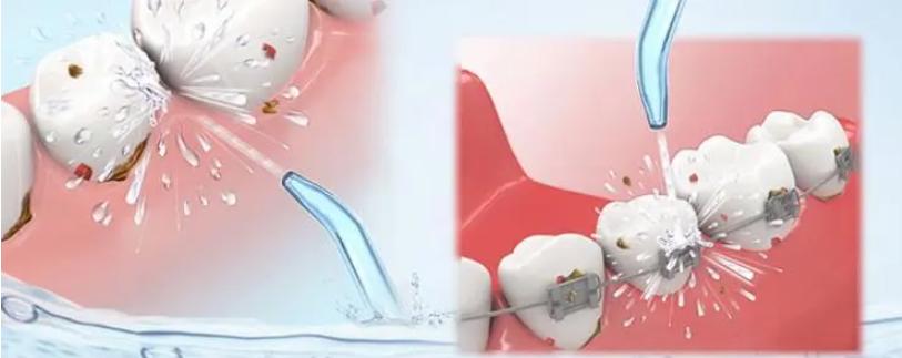 为什么有些人洗牙后牙齿会酸,为什么有些人洗牙会把牙齿洗松
