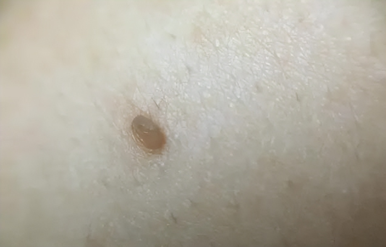 脖子腋下的小肉粒是什么,脖子腋下长小肉粒可以用手揪掉吗