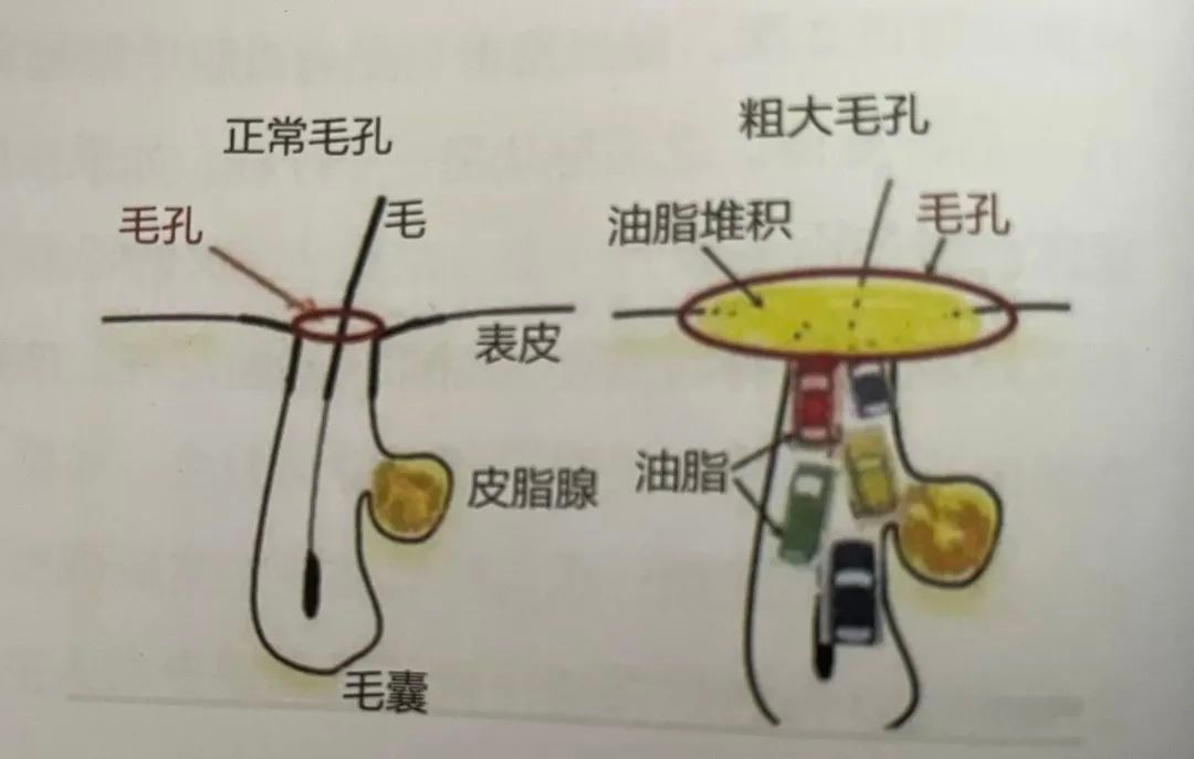 防止毛孔粗大如何护肤呢,敏感肌毛孔粗大护肤套装