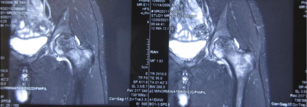 儿童股骨头坏死痊愈后能踢足球吗,踢足球导致股骨头坏死