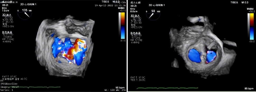 郑州大学第一附属医院心脏瓣膜,新技术治疗心脏瓣膜病