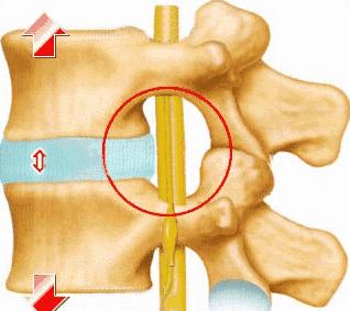 椎间盘突出膨出脱出如何治疗最好,椎间盘突出图怎么看