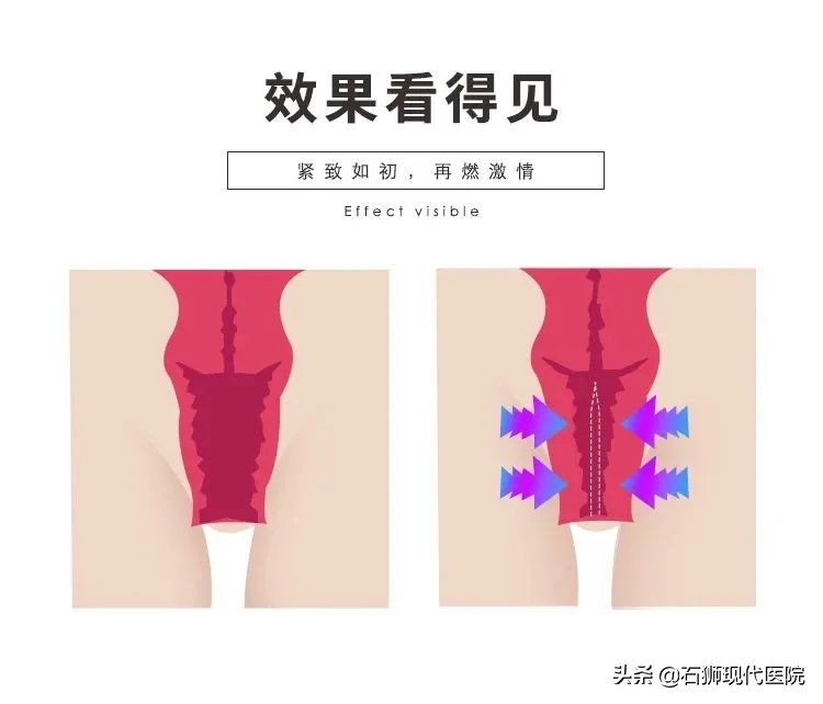 “快看她尿裤子了！”3D生物束带紧缩术帮你解决这些“社死瞬间”