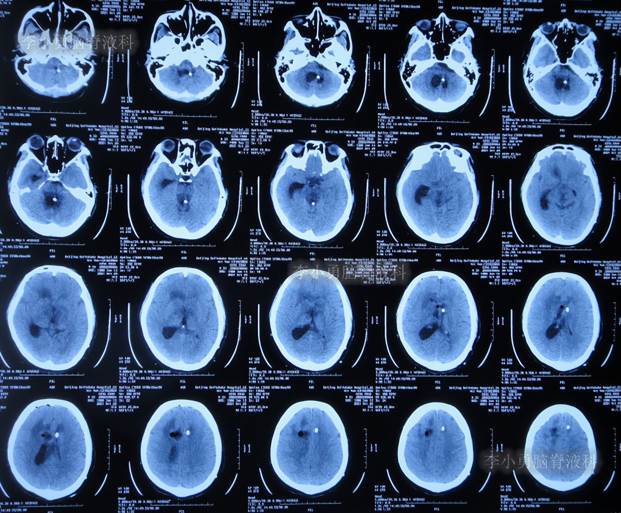 脑积水三脑室造瘘多久能恢复,脑囊虫手术后脑积水