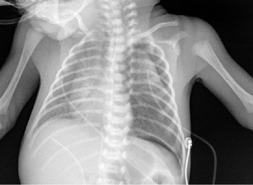 刚出生的小孩呼吸困难是怎么回事,小孩刚刚出生呼吸急促