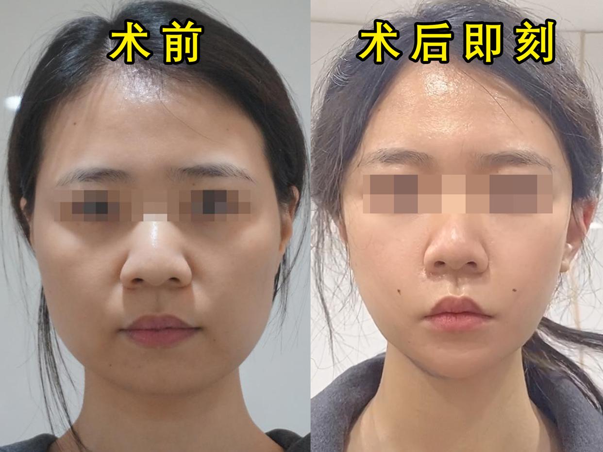 30岁女人做脸部美容,脸部面吸手术后的真实感受