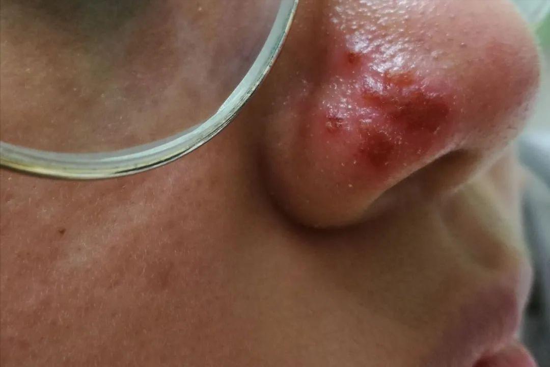 口唇边疱疹最好的治疗方法,口周疱疹