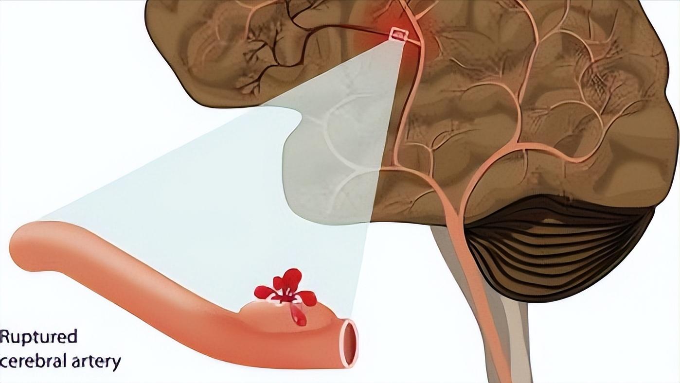 家人突发脑出血咋办？医生教你家庭急救办法，身边有高血压的请看