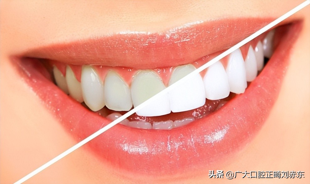 牙齿发黄变白用什么牙膏,牙齿发黄有牙垢怎么可以变白