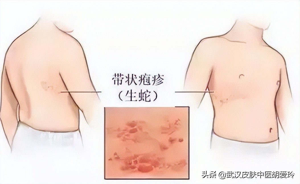 身上一燥热就像针扎一样刺痒,身上像针扎一样的感觉还有小红点