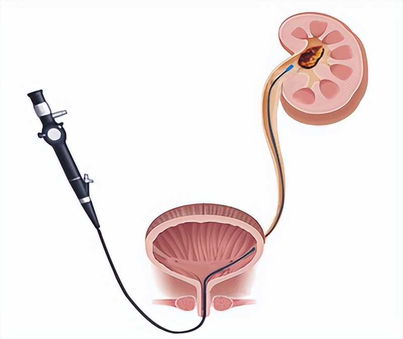 尿路结石碎石手术的缺点有哪些,泌尿结石体外碎石的副作用和危害