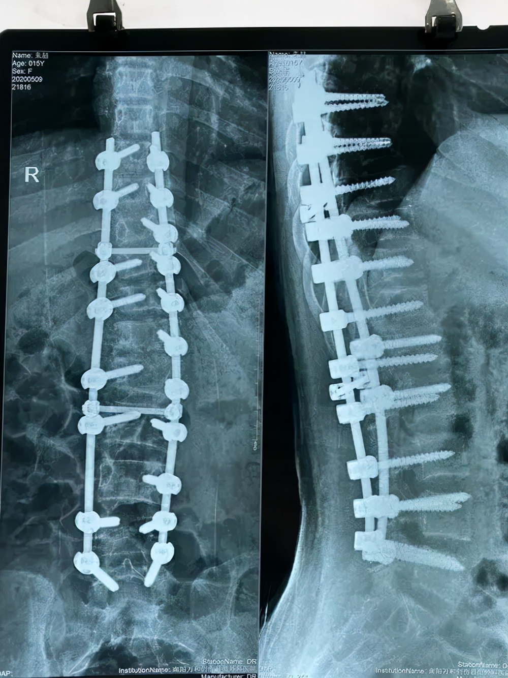 脊柱侧弯保守治疗可以报销吗,脊柱侧弯手术15万能报销多少