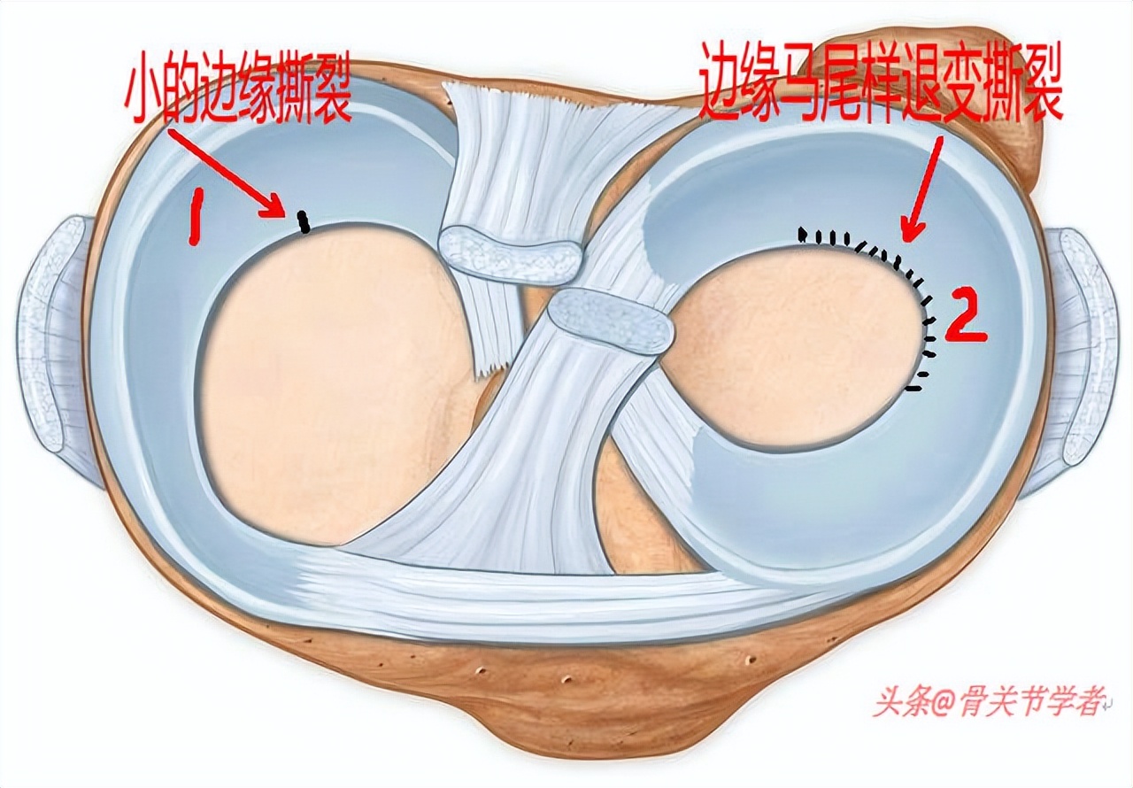 半月板损伤严重的状态是什么,半月板损伤应该注意什么问题