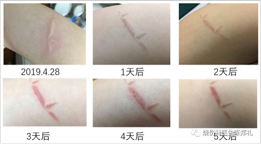 小孩不听话进厨房被烫伤,小朋友被油锅烫伤怎么办