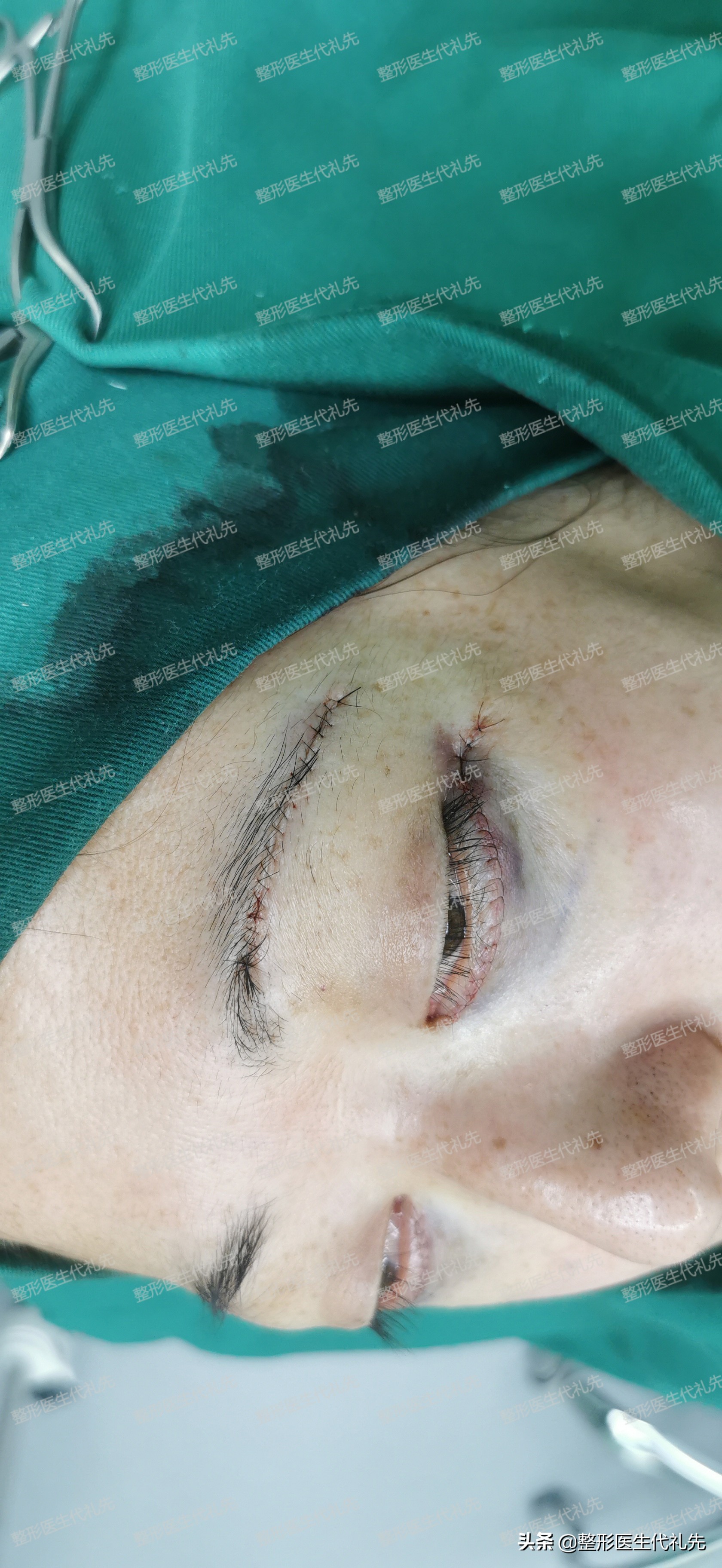 做提眉和外切眼袋恢复过程,提眉眼袋手术第9天