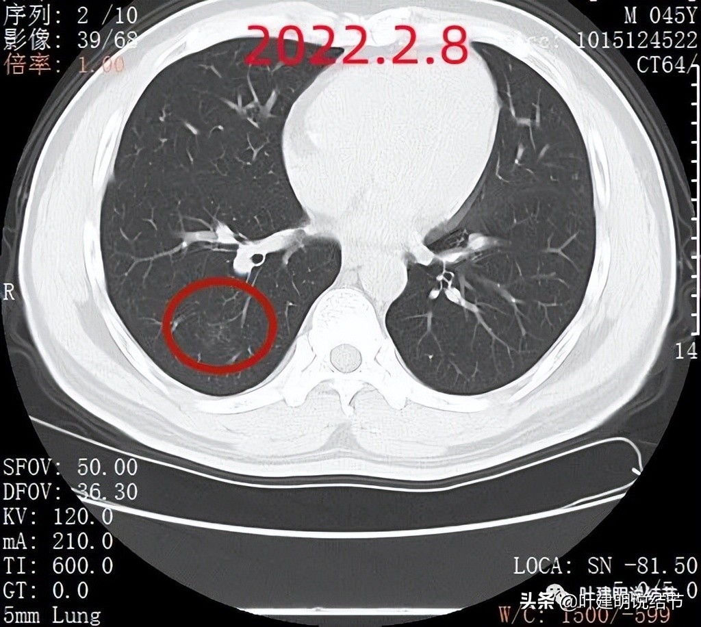 肺蜂窝状改变是肺癌吗,肺部陈旧灶与肿瘤怎么确诊