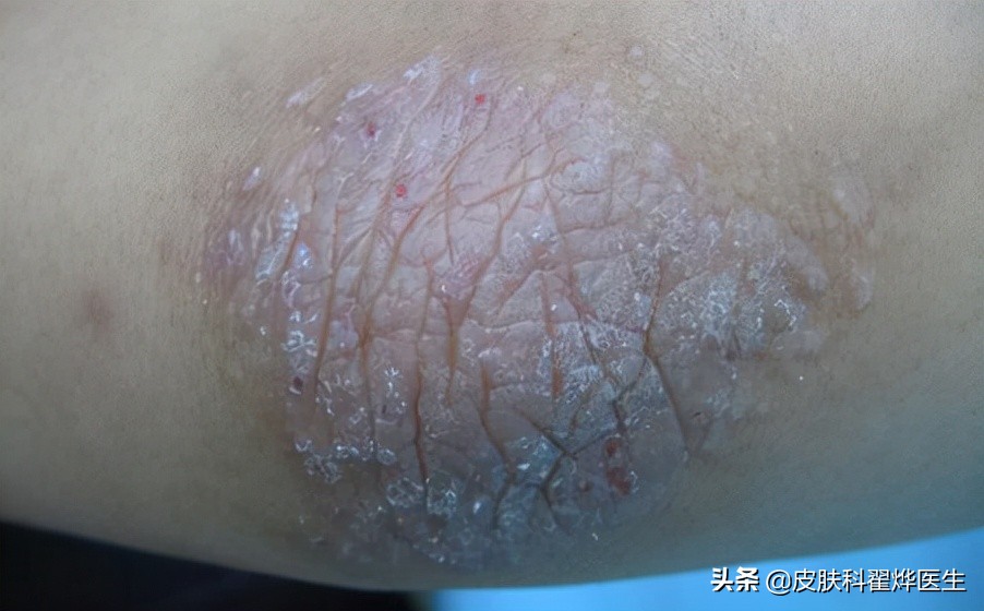 皮肤神经性皮炎怎么办,神经性皮炎要看皮肤科还是血液科