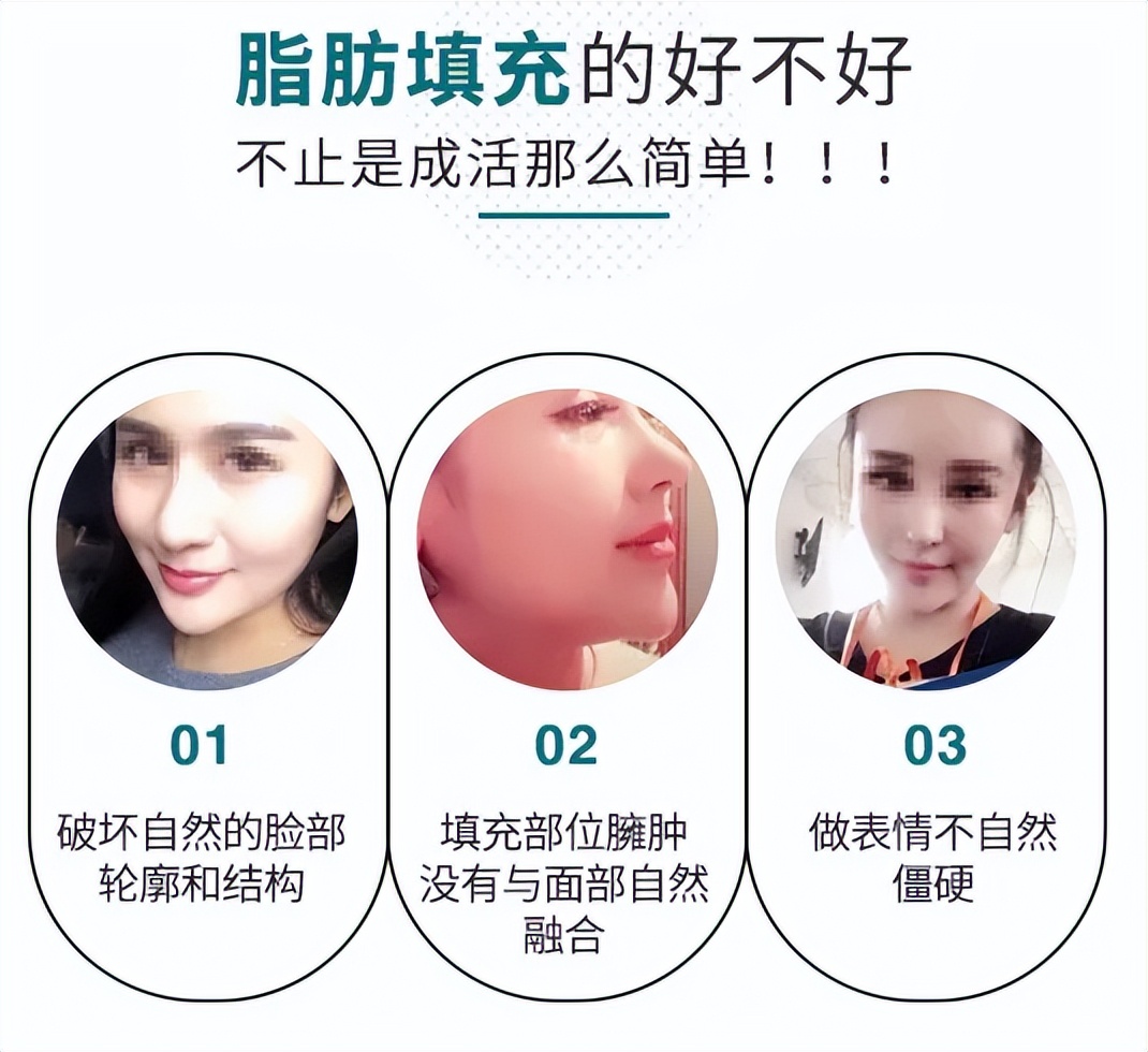 面部填充失败案例,脂肪填充面部失败案例